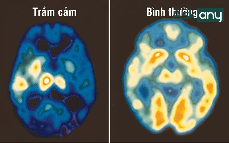 Bệnh trầm cảm là gì?